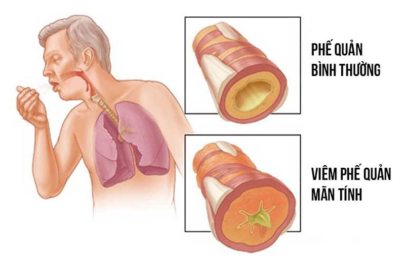 Giao mùa: Cẩn trọng với 6 bệnh đường hô hấp thường gặp