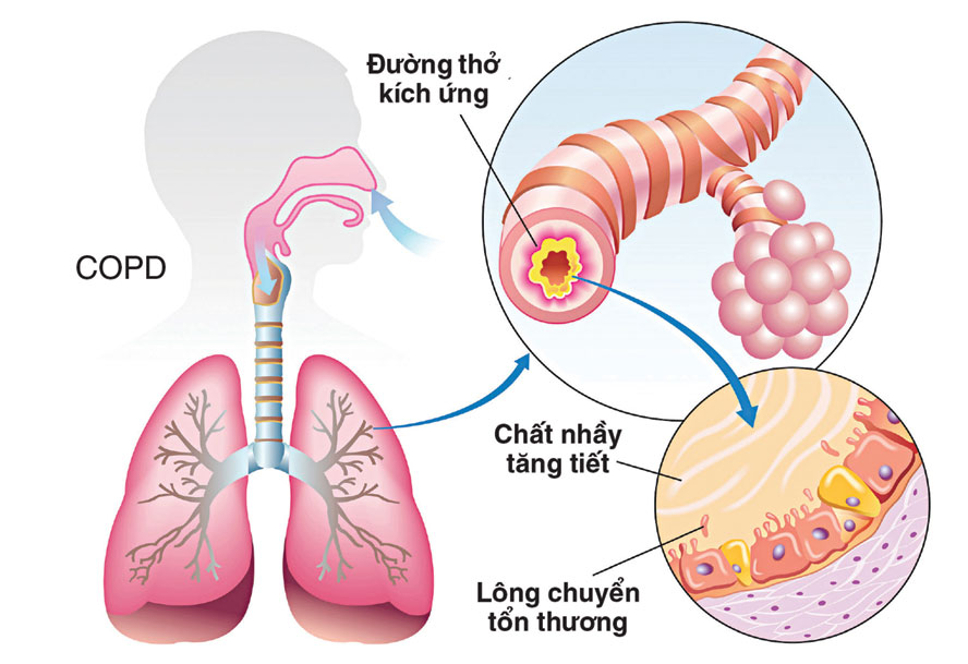 Bệnh phổi tắc nghẽn mãn tính thường gặp ở những đối tượng nào?