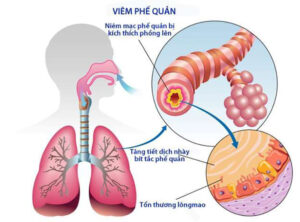 Điều trị viêm phế quản cấp