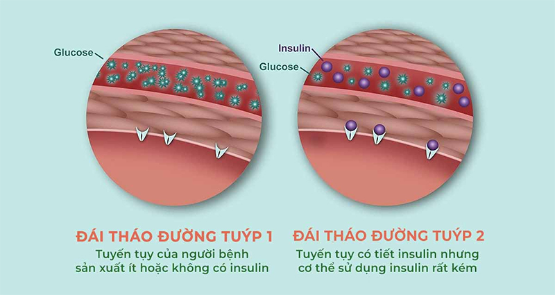 Sự khác biệt của bệnh tiểu đường tuýp 1, tuýp 2