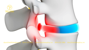Đau Lưng Là Dấu Hiệu Bệnh Gì?