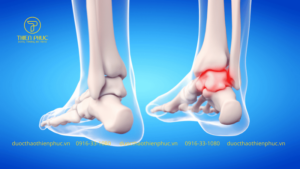 Bệnh Gout Có Chữa Được Không?